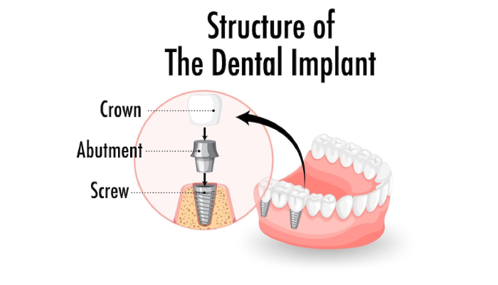 all on 4 dental implants pembroke pines