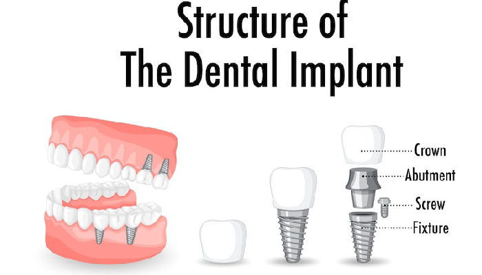 all on 4 dental implants pembroke pines